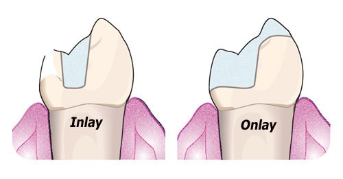 InlayOnlay2.jpg