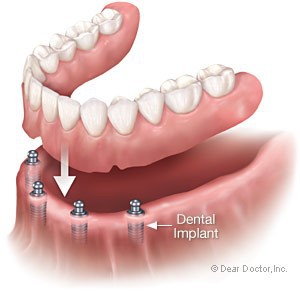 implant7.jpg